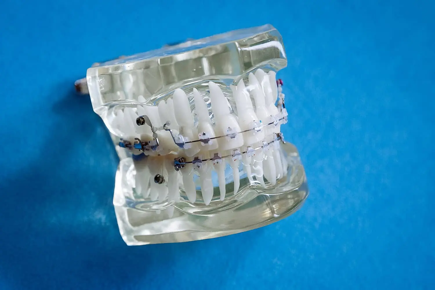 At Happy Smiles Orthodontics in St. Augustine, FL, a dental model displays upper and lower teeth fitted with metal braces and wires against a blue background.