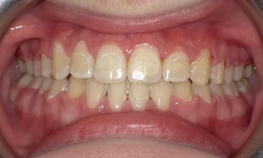 At Happy Smiles Orthodontics in St. Augustine, FL, a close-up reveals mostly aligned upper and lower teeth with mild crowding and slight redness of the upper gums following braces.