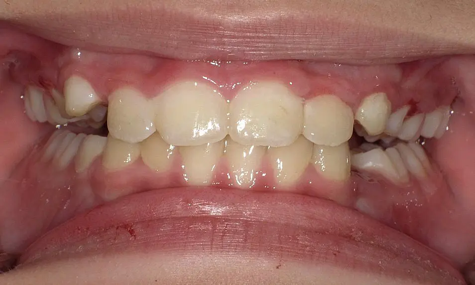 At Happy Smiles Orthodontics in St. Augustine, FL, misaligned and crowded teeth with visible gaps and uneven spacing—like those shown in this close-up—can be effectively corrected with braces.