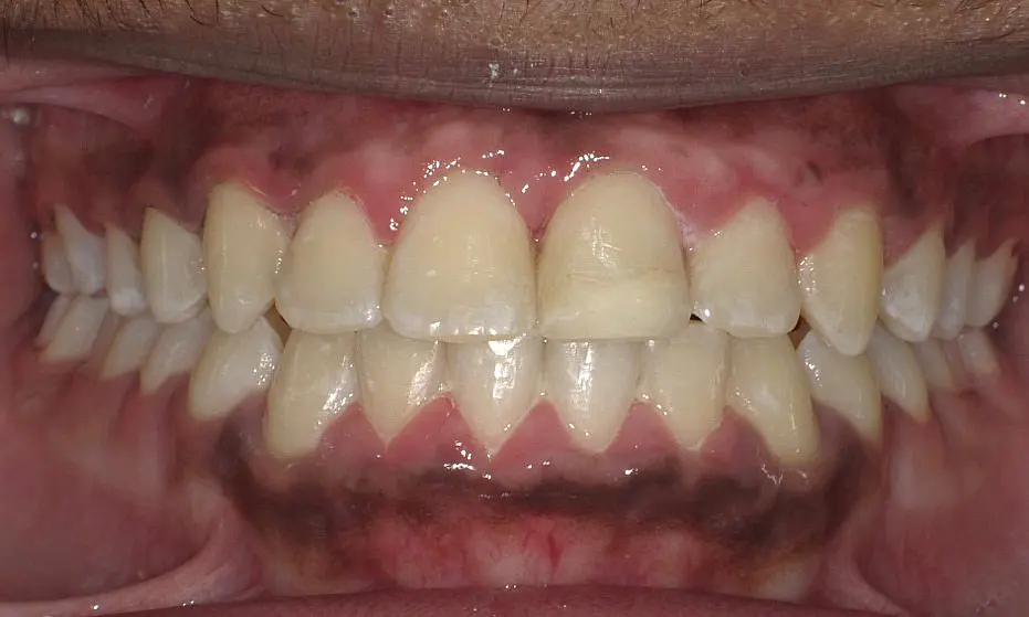 After braces treatment at Happy Smiles Orthodontics in St. Augustine, FL, a close-up reveals healthy upper and lower teeth with gums that appear healthy but show noticeable dark pigmentation along the lower gum line.