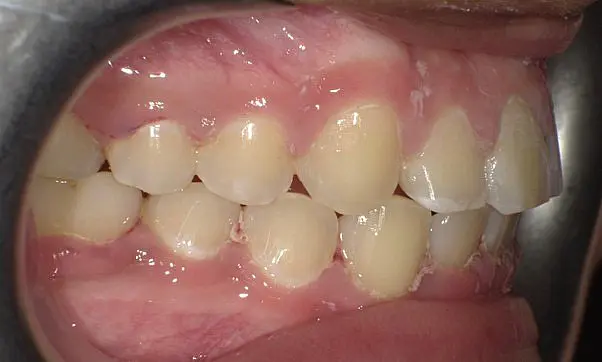At Happy Smiles Orthodontics in St. Augustine, FL, a close-up of teeth and gums after Invisalign reveals a corrected bite and improved lower teeth alignment.