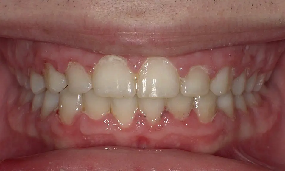 This close-up shows a dental examination at Happy Smiles Orthodontics in St. Augustine, FL, highlighting upper and lower teeth with mild crowding, visible gums, and plaque buildup after Invisalign treatment.