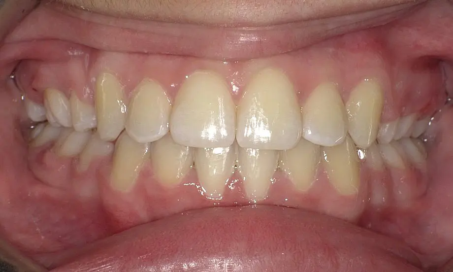 Visible in this close-up of a person's mouth are upper and lower teeth with mild crowding and gum tissue, following Invisalign treatment at Happy Smiles Orthodontics in St. Augustine, FL.