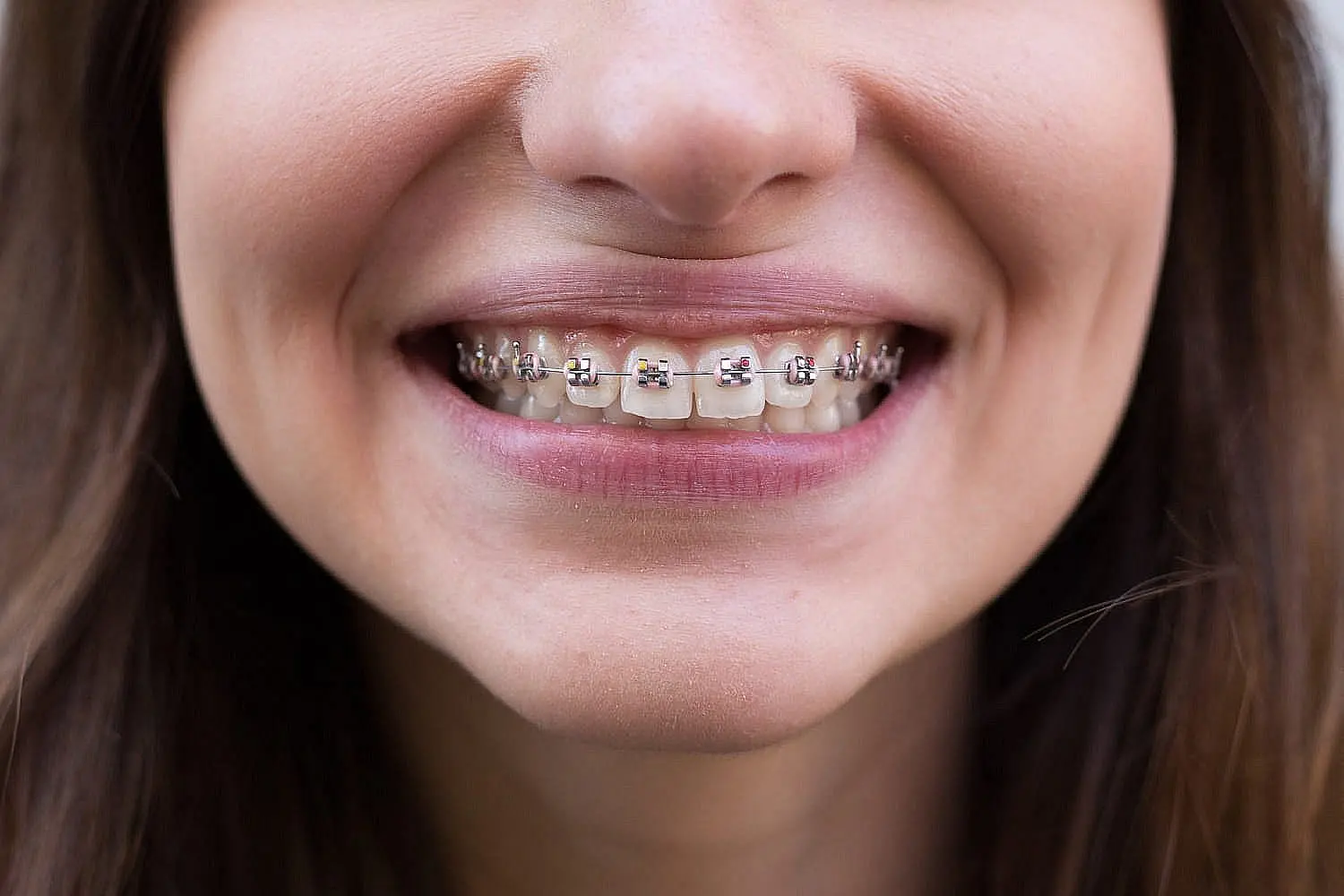 At Happy Smiles Orthodontics in St. Augustine, FL, a patient confidently smiles, revealing metal braces correcting their overbite.