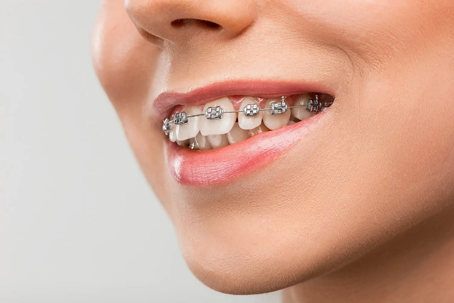 A patient at Happy Smiles Orthodontics in St. Augustine, FL, smiles in a close-up photo, revealing metal braces working to correct an overbite against a neutral background.
