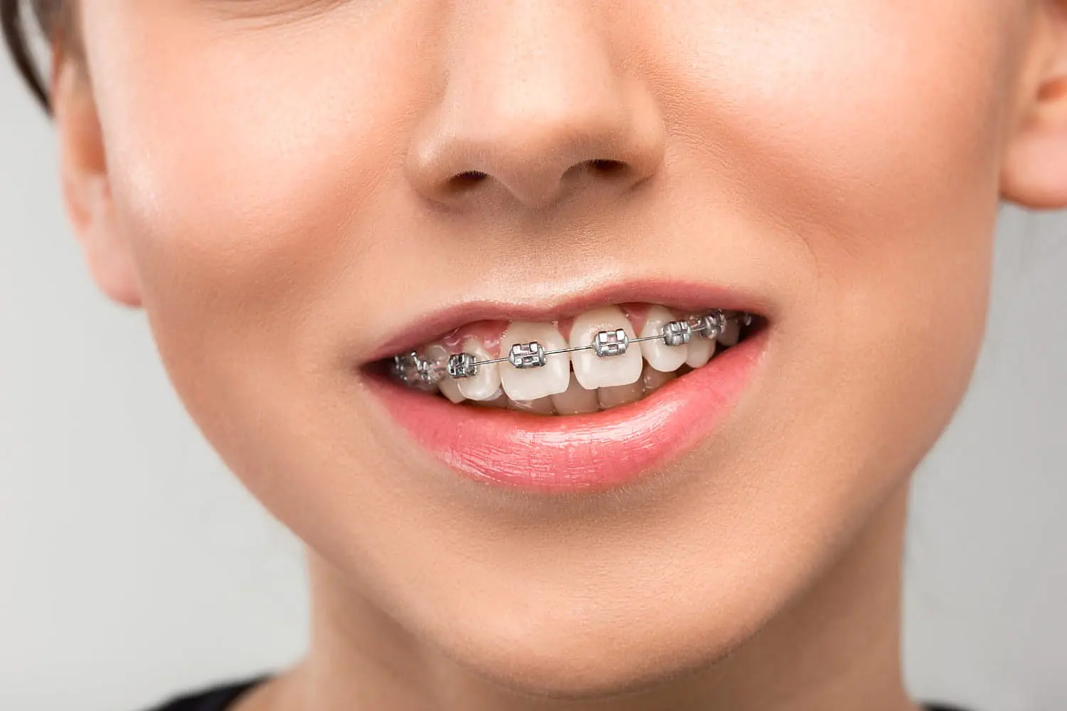 A close-up shows metal dental braces correcting an overbite on upper teeth, with light pink lipstick and slightly parted lips at Happy Smiles Orthodontics in St. Augustine, FL.