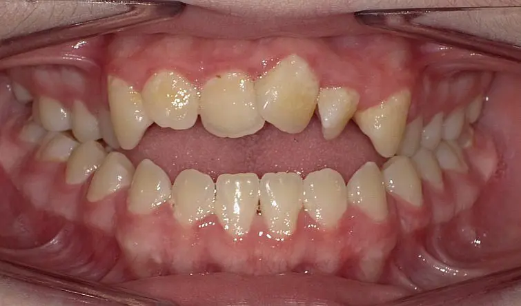A close-up of crooked, crowded teeth and visible gums—common before braces at Happy Smiles Orthodontics in St. Augustine, FL.