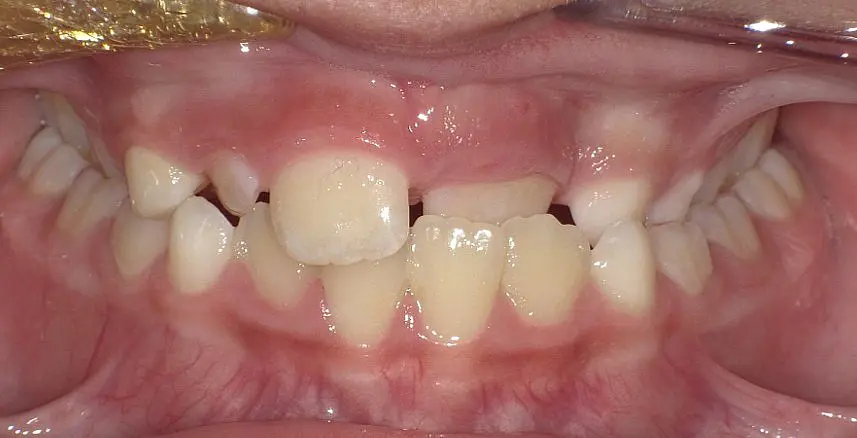 This close-up shows misaligned and crowded teeth with visible gums before braces at Happy Smiles Orthodontics in St. Augustine, FL.