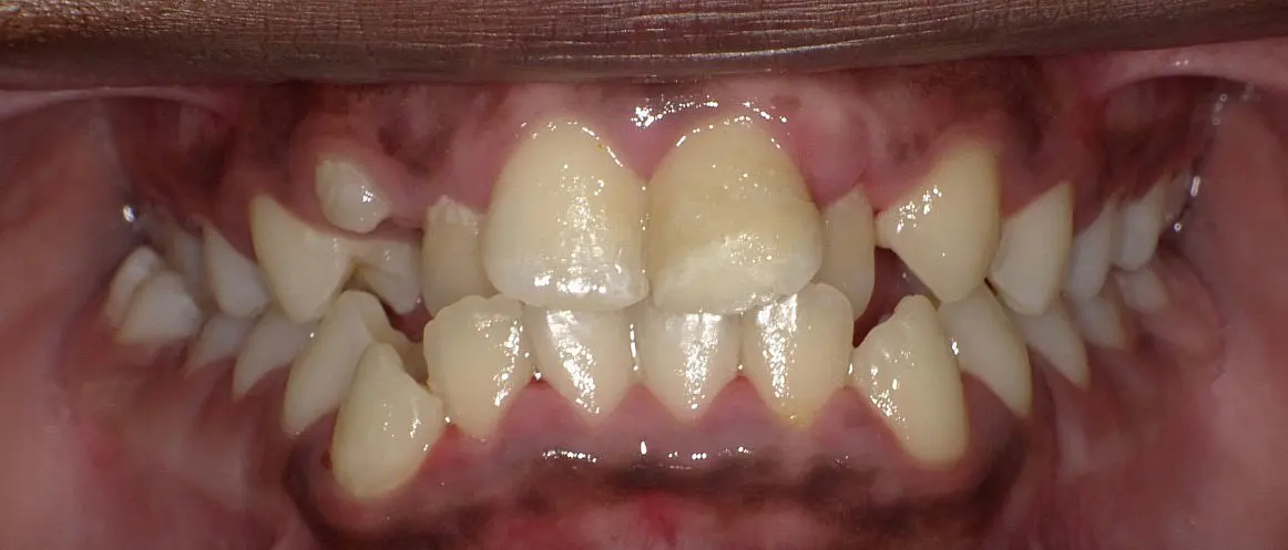 This close-up highlights misaligned upper and lower teeth with crowding and irregular spacing as seen before braces at Happy Smiles Orthodontics in St. Augustine, FL.