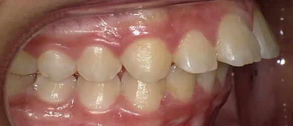 A side close-up of teeth and gums displays an overbite, with upper front teeth overlapping the lowers before Invisalign treatment at Happy Smiles Orthodontics in St. Augustine, FL.
