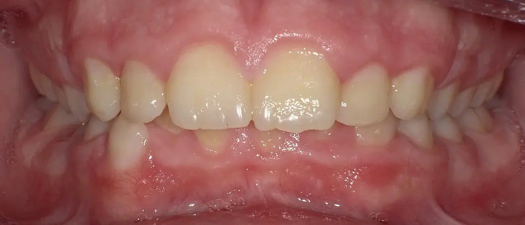 A close-up image displays a mild overbite and slight misalignment of the upper front teeth before Invisalign treatment at Happy Smiles Orthodontics in St. Augustine, FL.