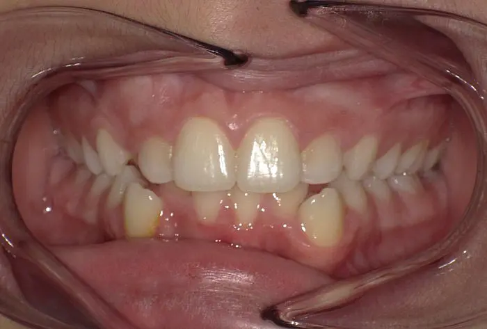 A close-up of a person's mouth at Happy Smiles Orthodontics in St. Augustine, FL, shows mild tooth misalignment and a slight gap between the upper front teeth before Invisalign treatment.