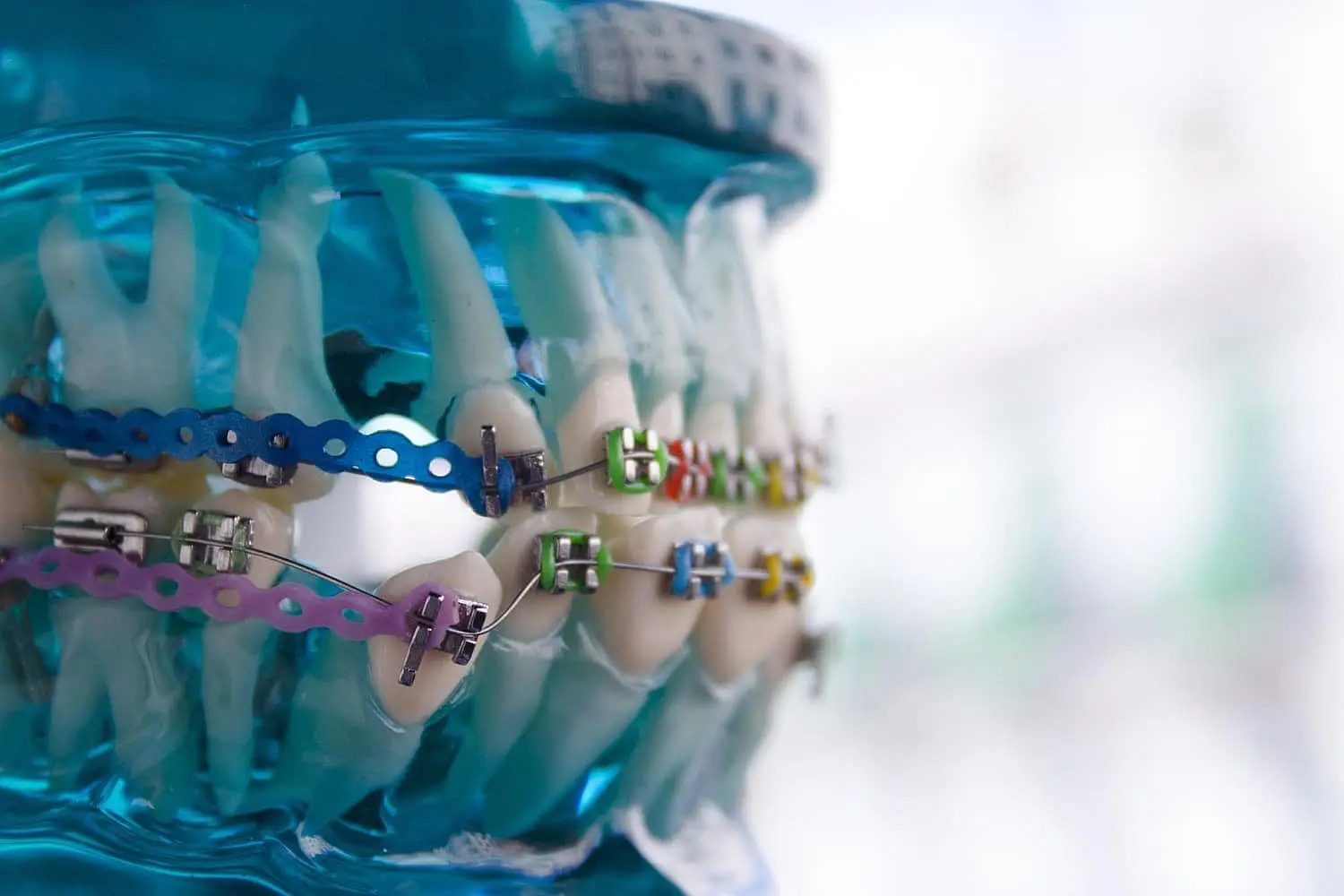 A dental model with metal braces, featuring colorful brackets and bands on artificial teeth, is displayed in the background at Happy Smiles Orthodontics in St. Augustine, FL.