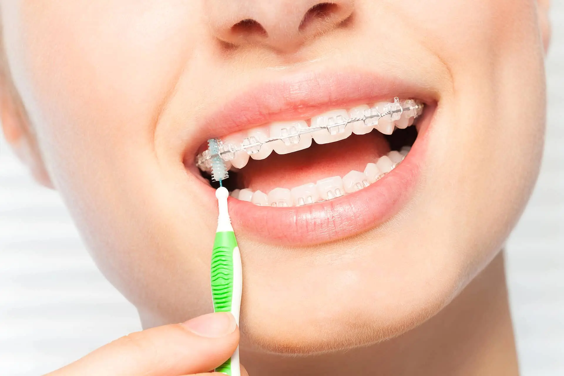 A person at Happy Smiles Orthodontics in St. Augustine, FL, smiles while cleaning their clear braces with an interdental brush, showcasing healthy teeth and good dental hygiene.