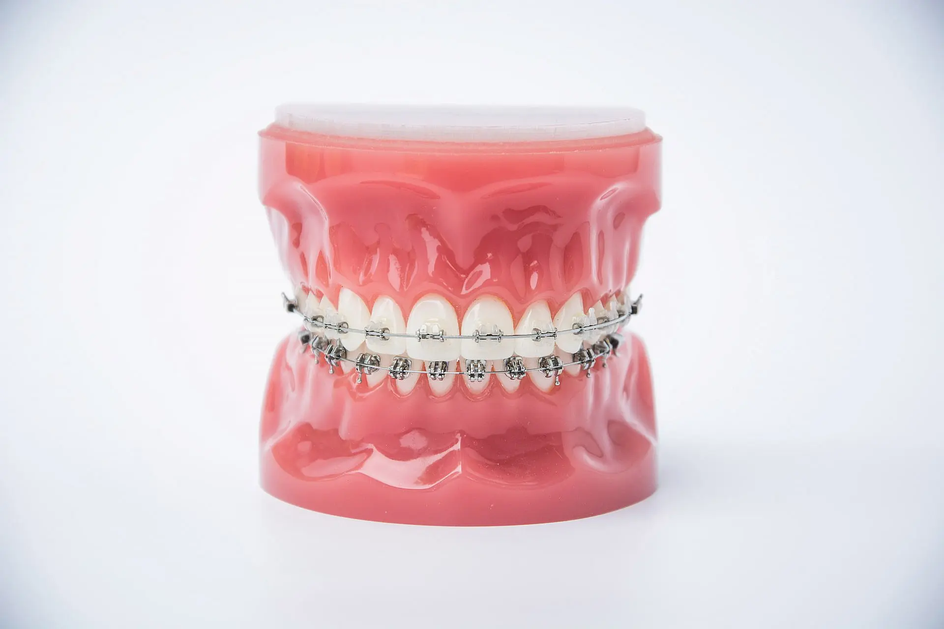 The dental model at Happy Smiles Orthodontics in St. Augustine, FL, showcases upper and lower teeth with metal braces, clearly highlighting their structure and design.