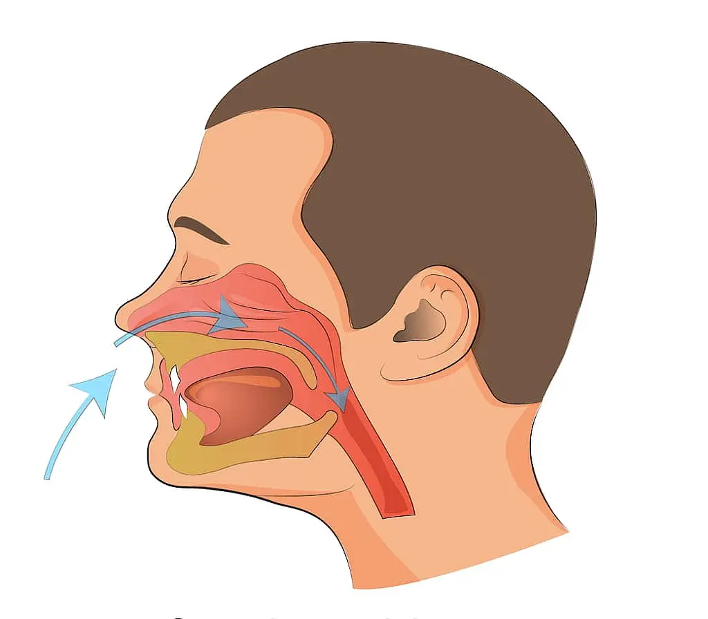 An illustration used by Happy Smiles Orthodontics in St. Augustine, FL depicts a human head in profile, showing how mouth breathers direct airflow mainly through the mouth and airway instead of the nasal cavity.