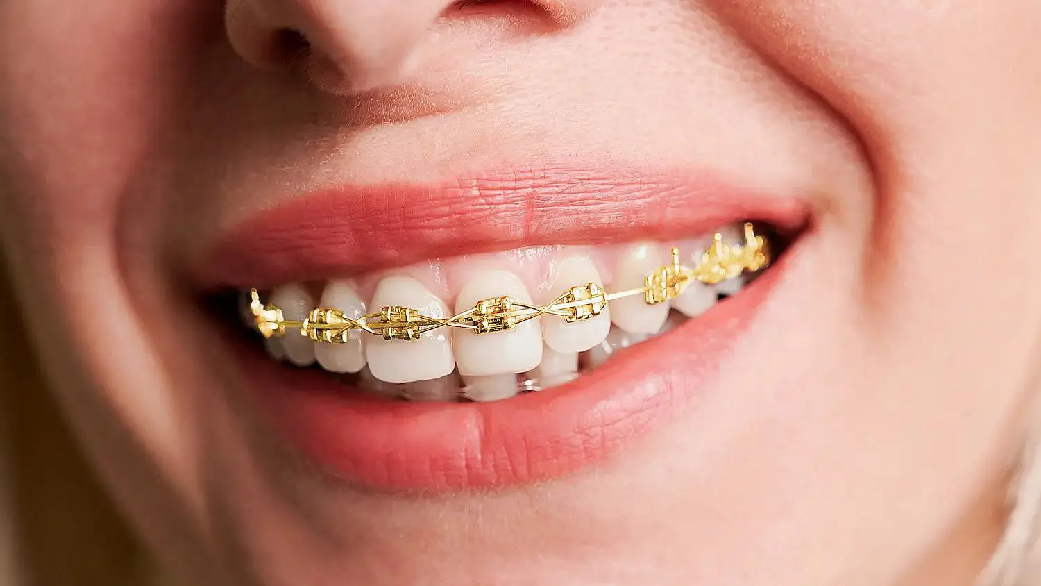 A confident smile showcases Gold Braces at Happy Smiles Orthodontics in St. Augustine, FL.