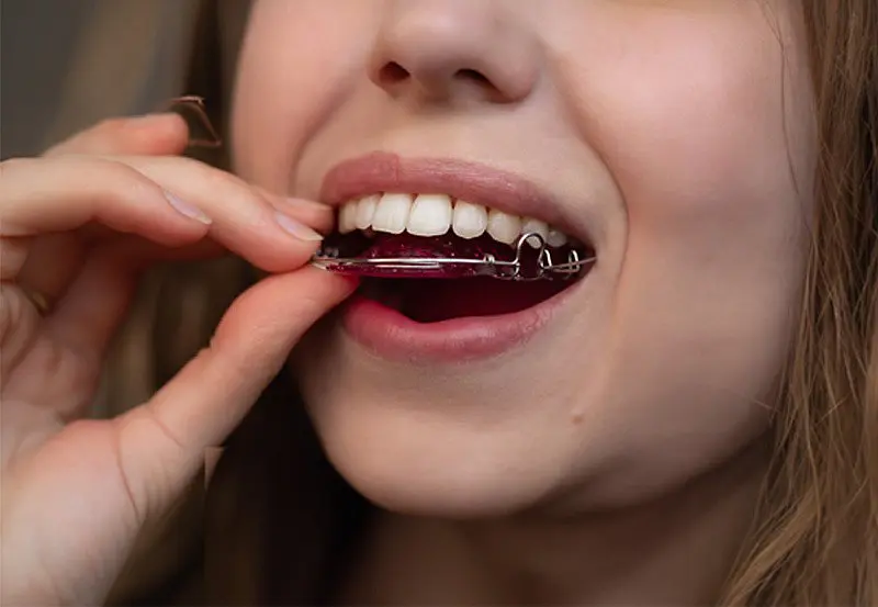 At Happy Smiles Orthodontics in St. Augustine FL, an individual holds a Hawley Retainer while placing it in their mouth and displaying their teeth.