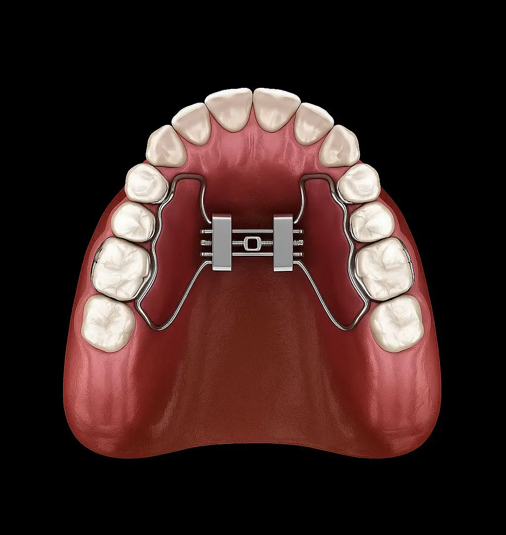 An upper jaw with a palatal expander attached to the molars is displayed on a black background by Happy Smiles Orthodontics in St. Augustine, FL.