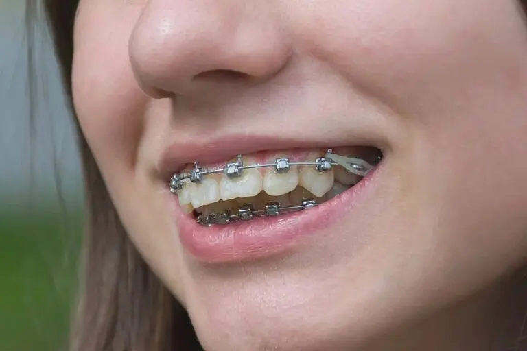 Close-up of a smiling patient showing metal braces on teeth – braces for overbite in St. Augustine, FL.