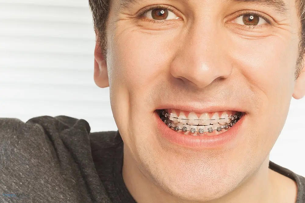 happy young man with metal braces - Overbite vs Underbite in St. Augustine, FL 