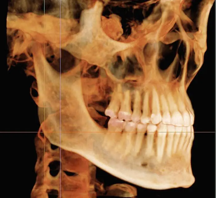 Detailed 3D skull scan in profile view, highlighting teeth and jaw at Happy Smiles Orthodontics in St. Augustine, FL.