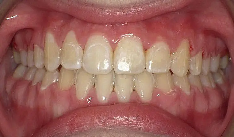 Open mouth showing gum recession and tooth discoloration, common after braces at Happy Smiles Orthodontics in St. Augustine, FL.