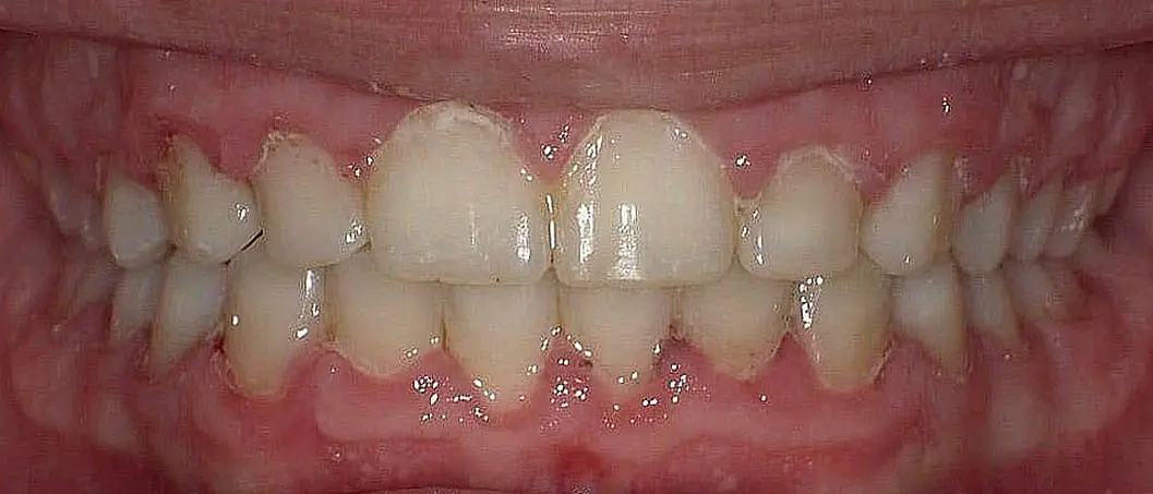 After Invisalign at Happy Smiles Orthodontics in St. Augustine, FL: close-up of teeth with moderate crowding and overlap.