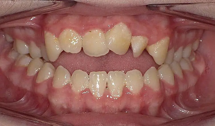 Before braces at Happy Smiles Orthodontics in St. Augustine, FL: close-up of a mouth with crowded, uneven teeth and visible gums.